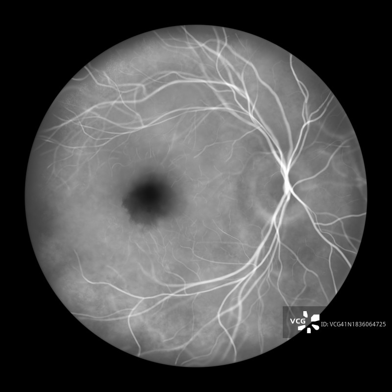 黄斑下出血插图图片素材