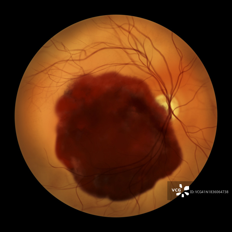 视网膜下出血插图图片素材