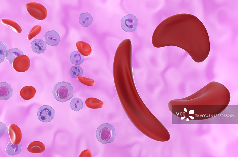 镰状细胞贫血症插图图片素材
