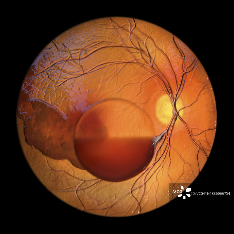 特尔松综合征眼内出血插画图片素材