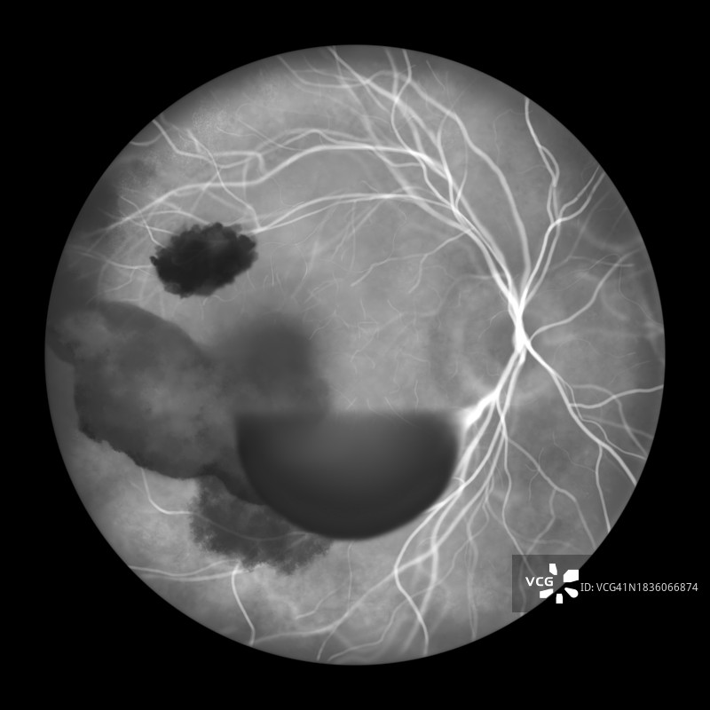 特尔松综合征眼内出血插画图片素材