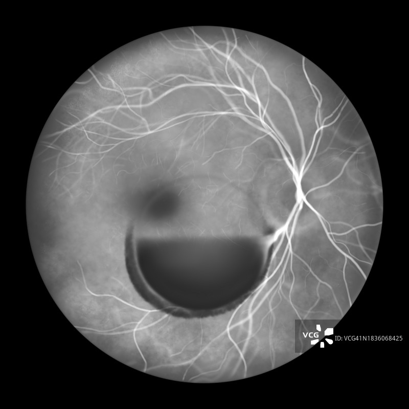 瓦尔萨瓦视网膜病变插图图片素材