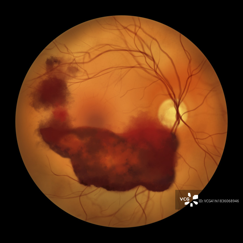 玻璃体出血插图图片素材