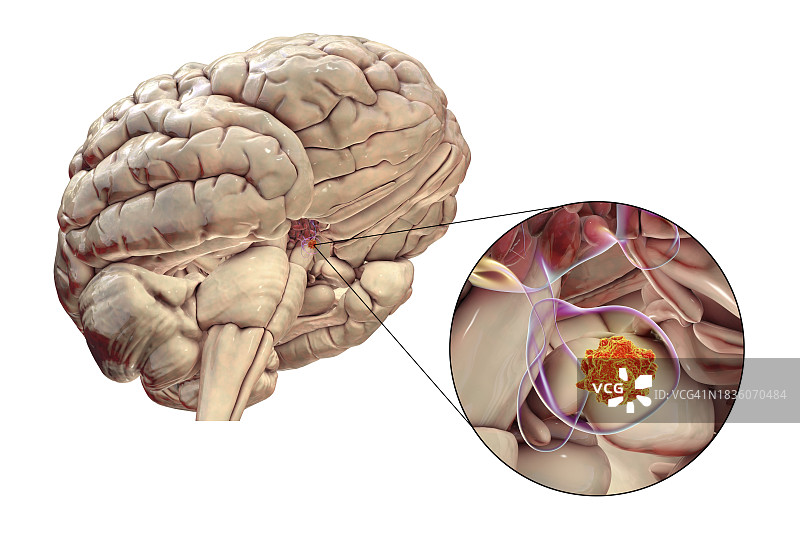 脑垂体肿瘤插图图片素材