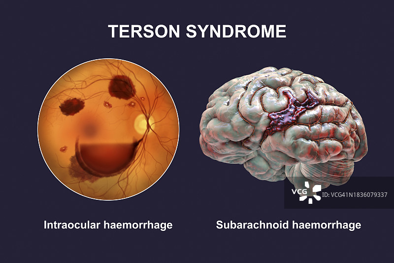 特森综合征插图图片素材