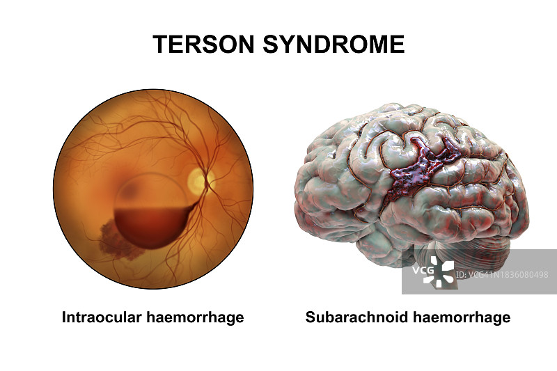 特森综合征插图图片素材