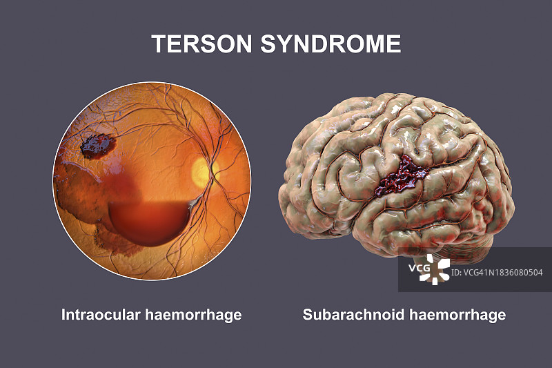 特森综合征插图图片素材