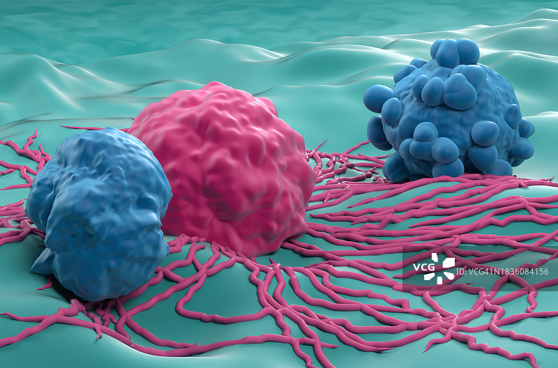 甲状腺癌图示图片素材