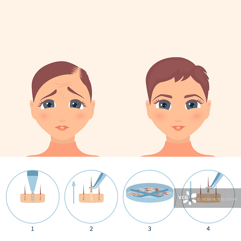 毛囊单位提取（FUE）头发移植概念图图片素材