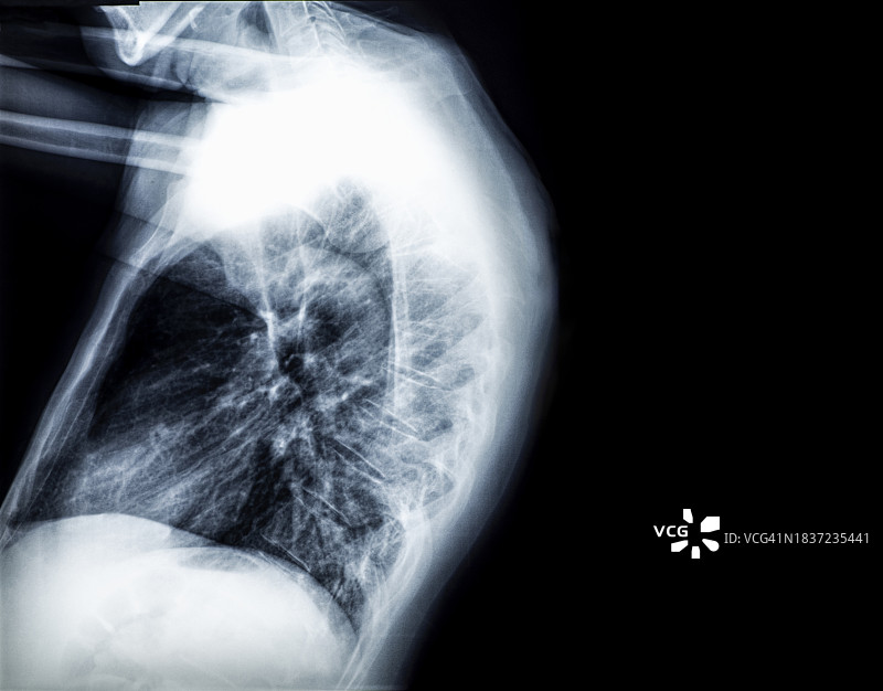 成人脊柱侧弯X光片（背面）图片素材
