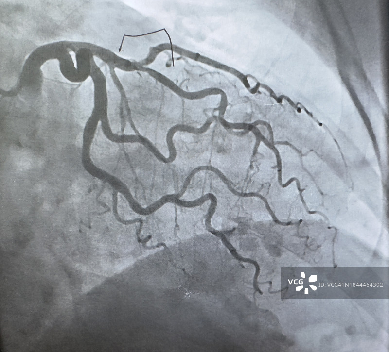 心脏周围静脉的核磁共振扫描图片素材