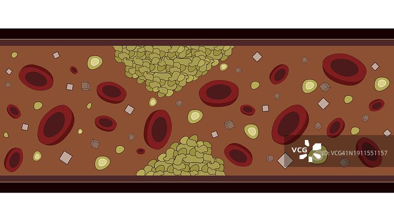 动脉脂肪健康问题抽象图片图片素材