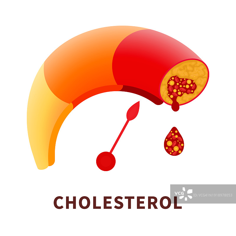 动脉粥样硬化概念图图片素材