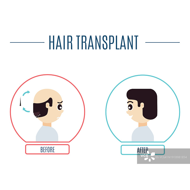 植发概念插图图片素材