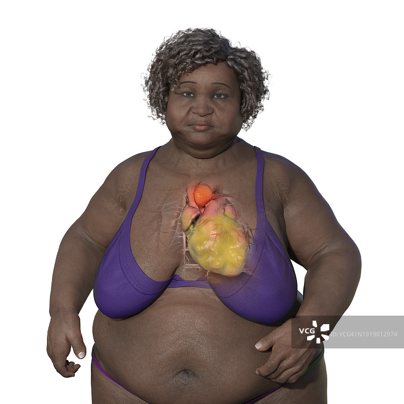 患有升主动脉瘤的肥胖妇女插图图片素材