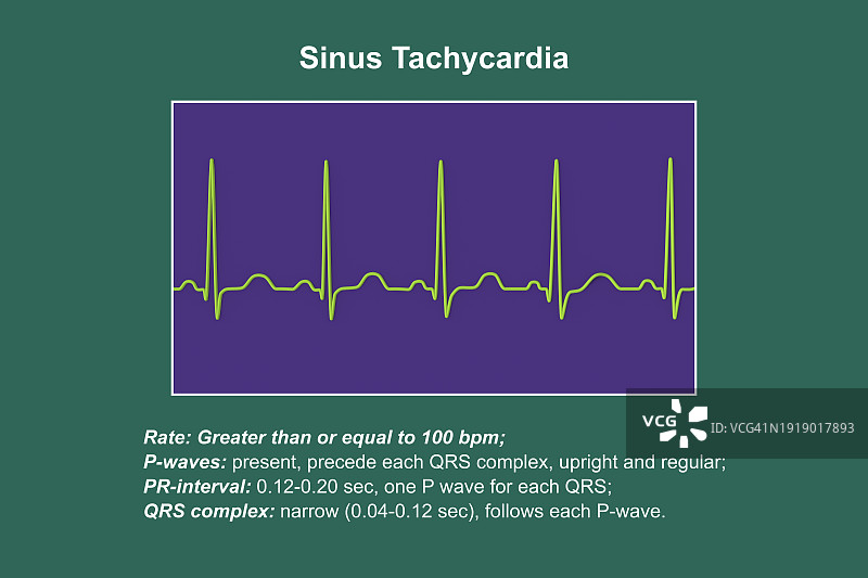 窦性心动过速心跳节律图图片素材