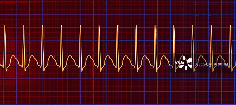 室上性心动过速心跳节律图示图片素材