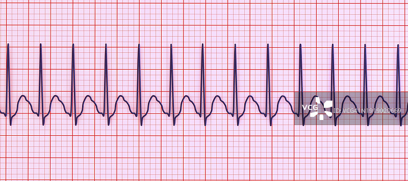 室上性心动过速心跳节律图示图片素材