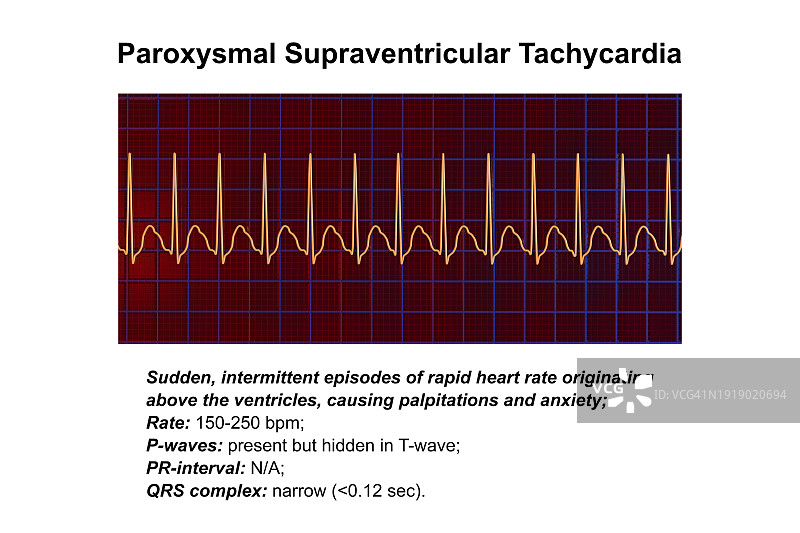 室上性心动过速心跳节律图示图片素材
