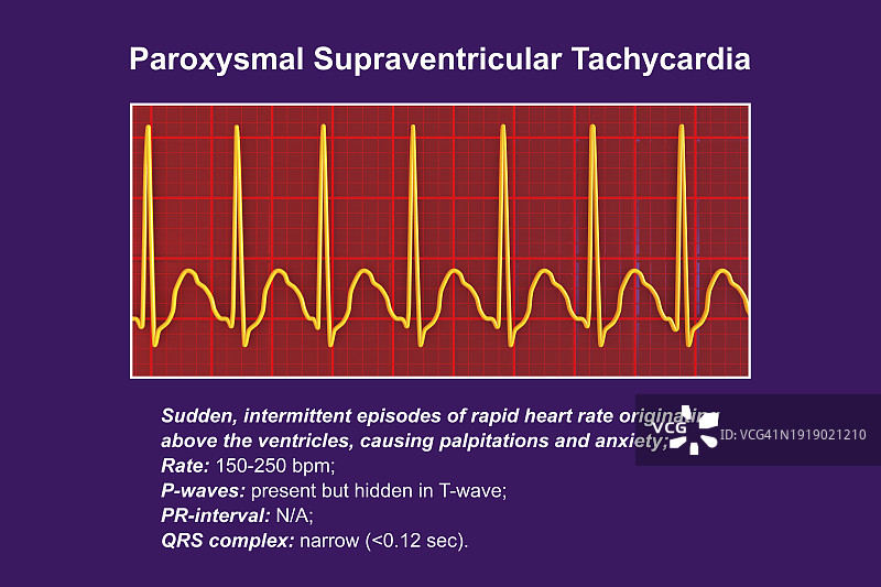 室上性心动过速，心律图图片素材