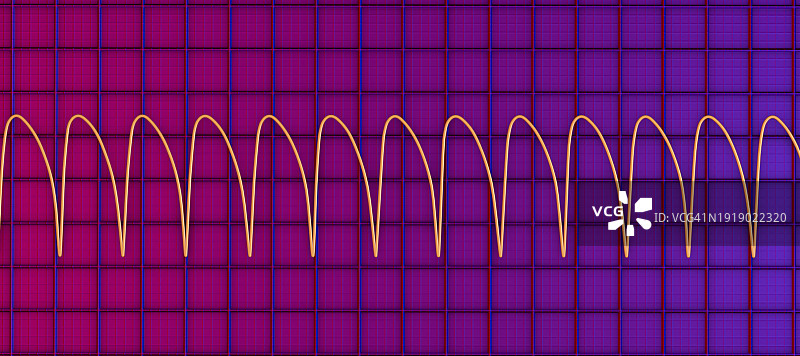 室性心动过速心跳节律图图片素材