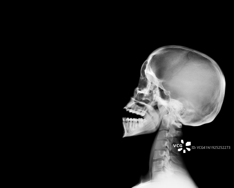X光下的骷髅图片素材