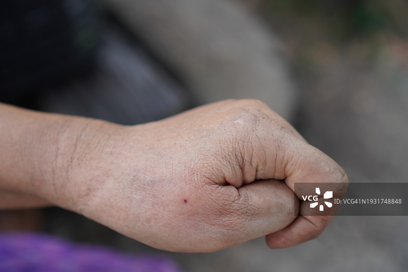 大黄蜂蛰伤拇指图片素材