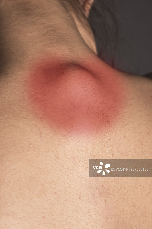 背部疼痛图片素材