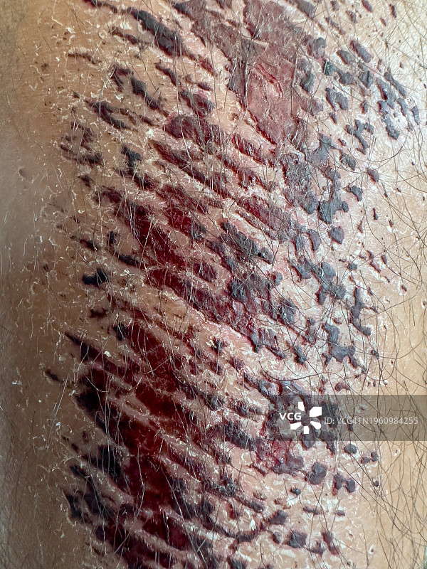 男人腿上的大伤疤图片素材