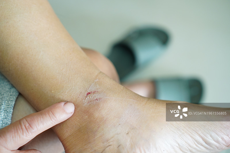 大黄蜂蜇伤女人脚踝图片素材