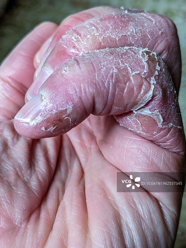 莱姆病导致的手指脱皮特写图片素材