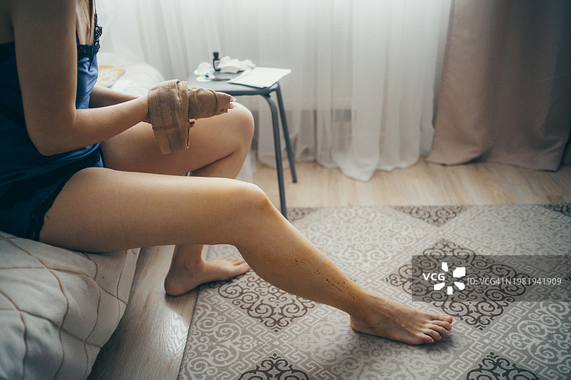 腿部静脉曲张切除术后的女人图片素材