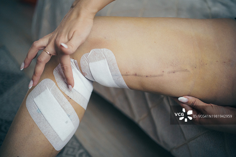 腿部静脉曲张切除术后的女人图片素材