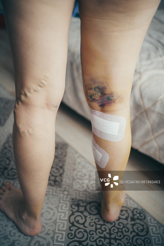 腿部静脉曲张切除术后的女人图片素材