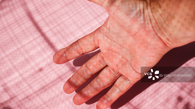 粉色背景上手部过敏图片素材