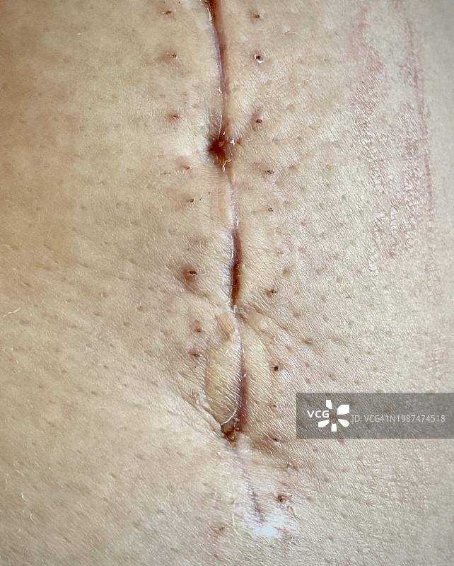 外科手术伤口图片素材