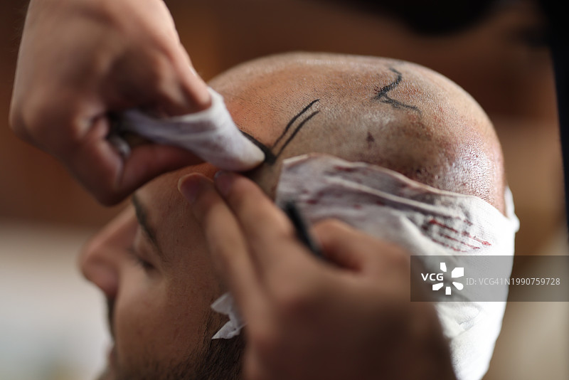 毛发移植图片素材