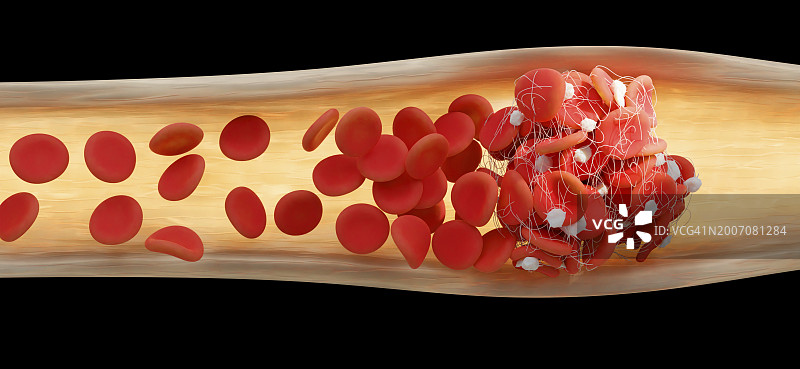 血块，插图图片素材