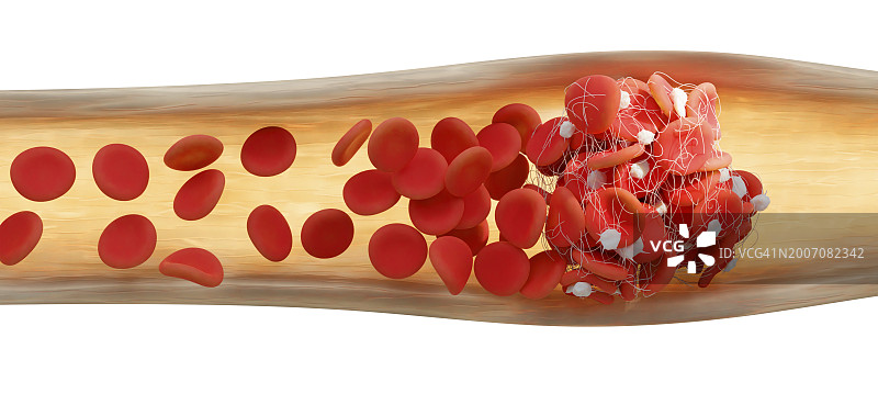 血块，插图图片素材