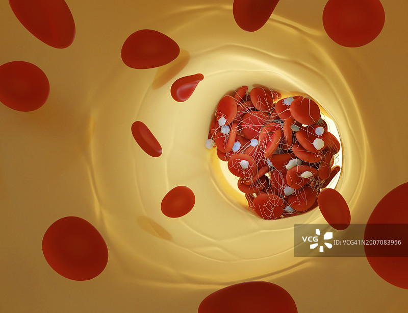 血块，插图图片素材