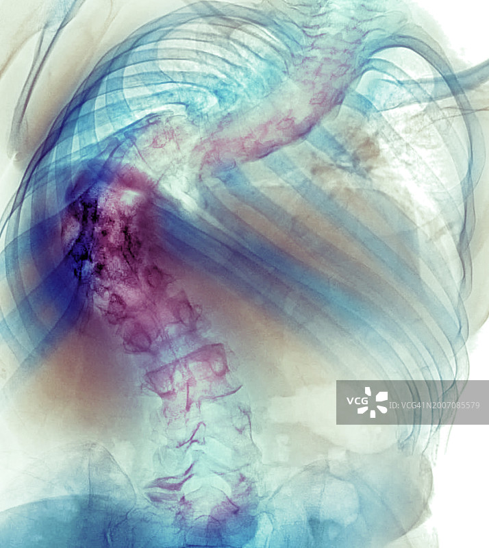 脊柱侧弯X光片图片素材