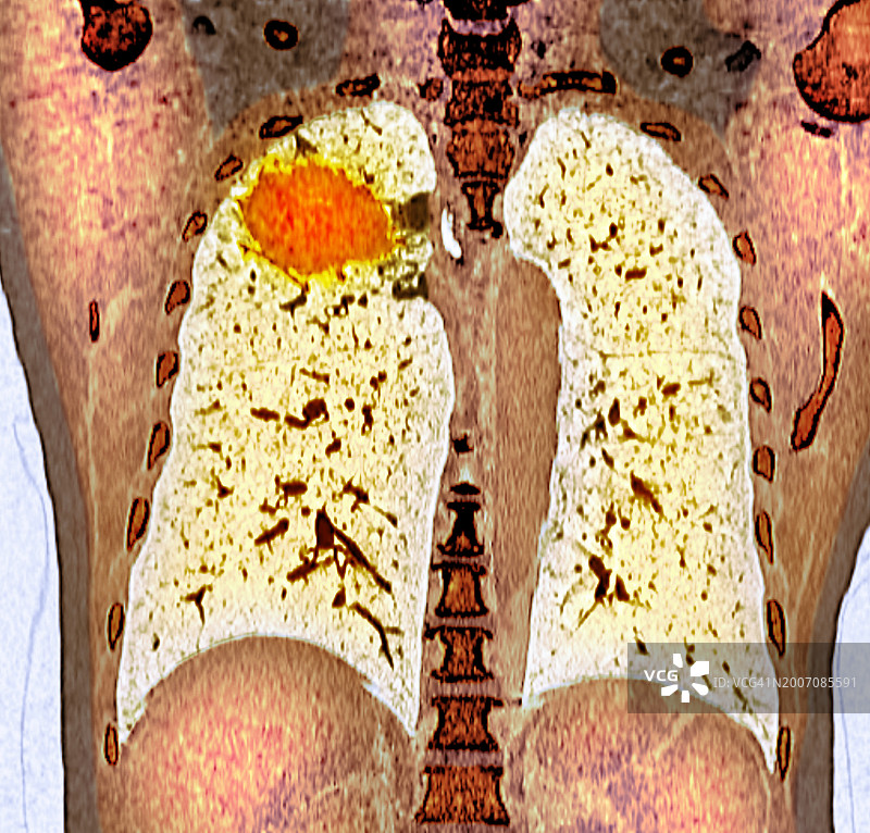 肺癌CT扫描图片素材