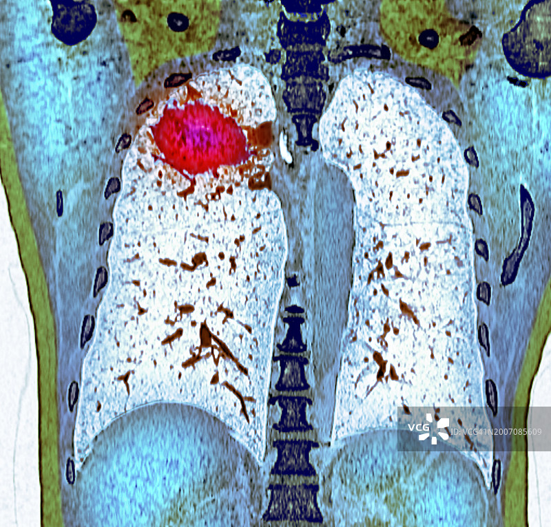 肺癌CT扫描图片素材