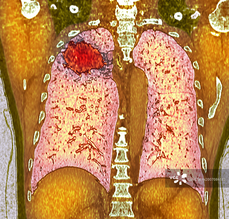 肺癌CT扫描图片素材