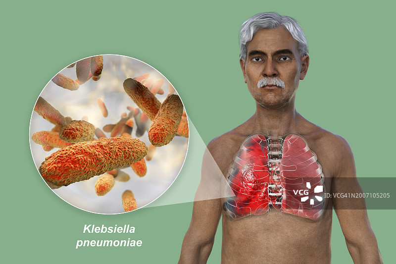 肺炎影响肺部的男人插画图片素材