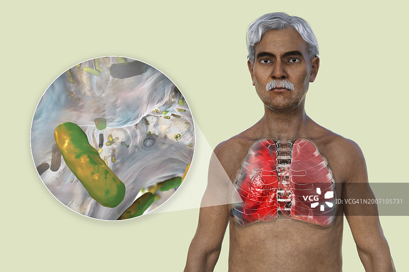 肺炎影响肺部的男人插画图片素材