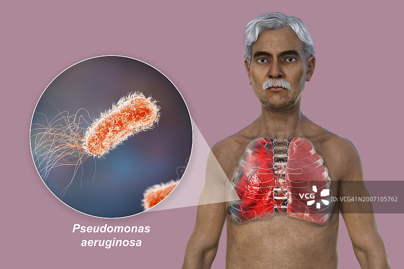 肺炎影响肺部的男人插画图片素材