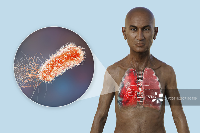 肺炎影响肺部的男人插画图片素材