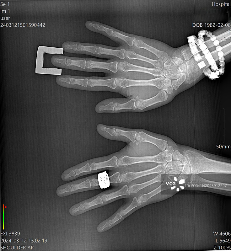 带有识别标记的双侧手部X光片医学放射影像图片素材