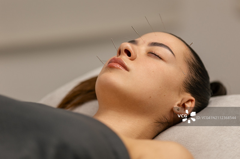 面部针灸治疗图片素材